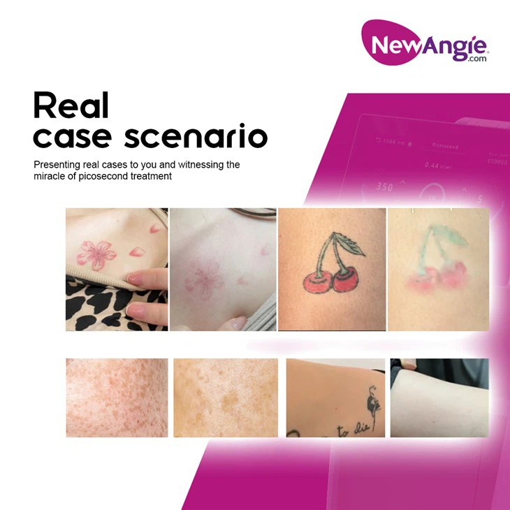 Picosecond Laser Tattoo Removal Machine