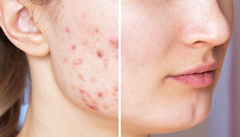 Thulium Laser Facial Before After: Acne Scars & Pore Minimization