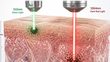 Can A YAG Laser Be Used To Remove Dark Spots