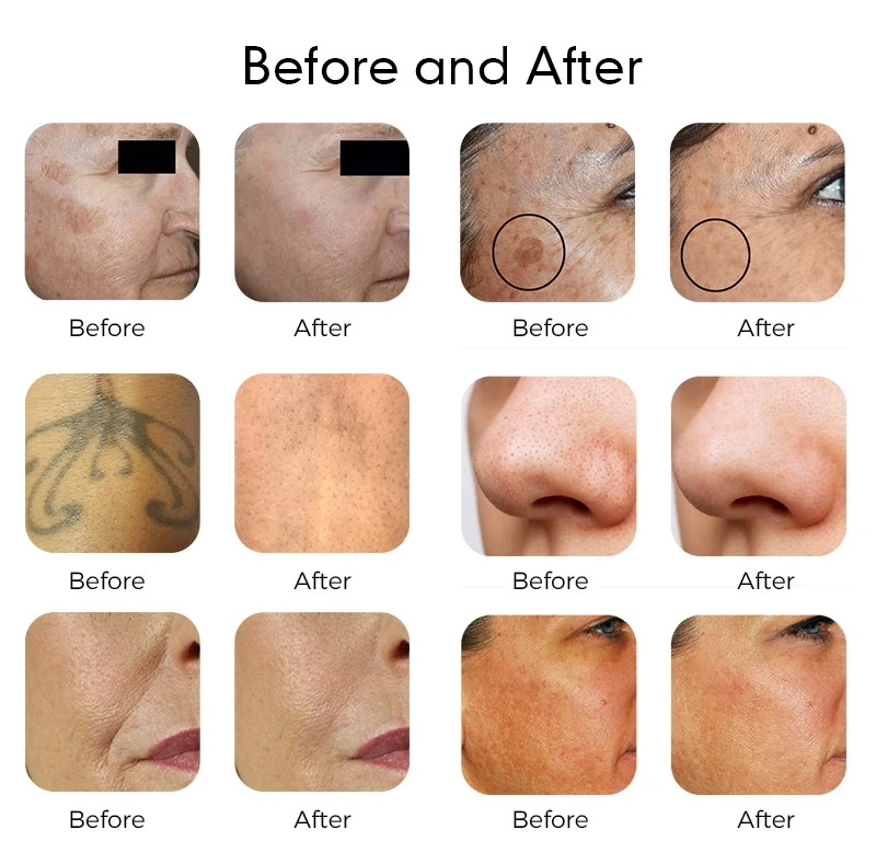 pico pro q switch laser tattoo removal pico pro q switch laser tattoo removal